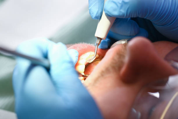Best Emergency Root Canal Treatment in Columbia City, OR